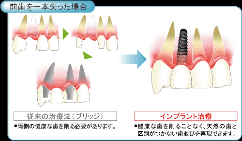 前歯を一本失った場合