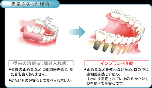 奥歯を失った場合