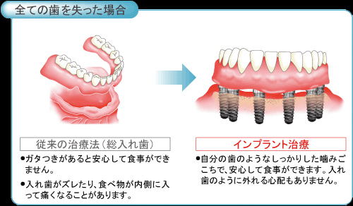 全ての歯を失った場合