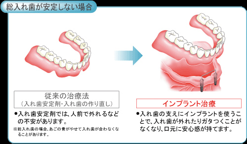 総入れ歯が安定しない場合