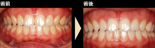 症例1 ホワイトニング